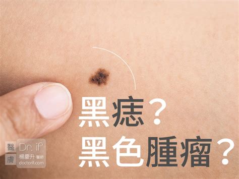 黑色的痣|不大驚小怪！如何辨別「黑痣」與「黑色腫瘤」？ 